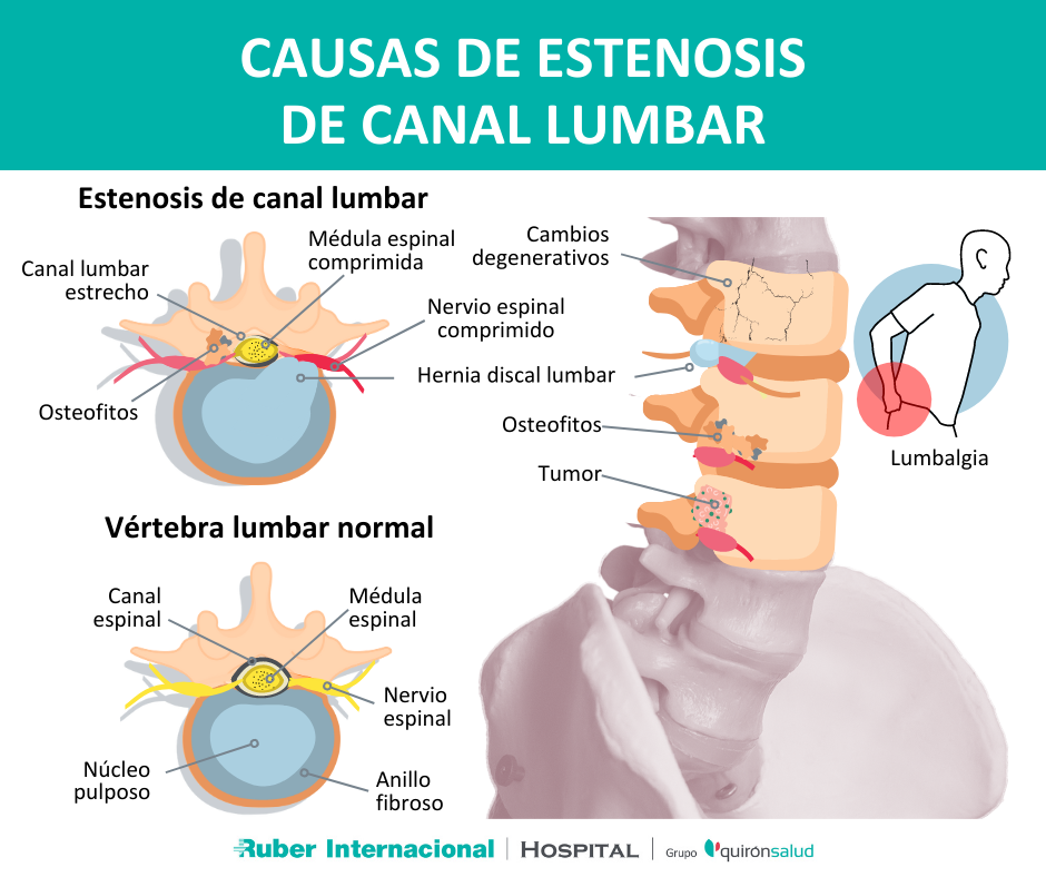 Anillo lumbar discount